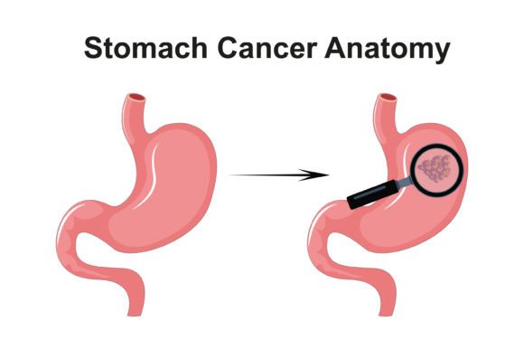 Download Stomach Cancer Anatomy Diagram Vector - Vector Collection