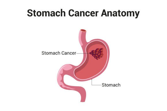 Download Stomach Cancer Anatomy Diagram Vector - Vector Collection